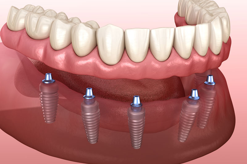 a full set of denture implants that have 6 implants placed into the jaw